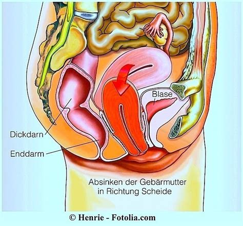 Ein kompletter leistenbruch bei der frau äußert sich meistens durch eine vorwölbung oder verdickung im unterbauch, die schmerzhaft sein kann. Gebärmuttersenkung, Operation, Gebärmuttervorfall, Geburt ...