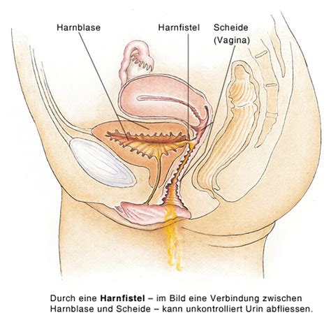 Was der kinderreim so unschuldig proklamiert, ist heutzutage alltag. Harnfistel, Urinfistel - eesom Gesundheitsportal