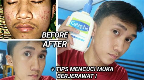 Elakkan dari menggunakan skrub muka. SABUN UNTUK KULIT BERJERAWAT + TIPS MENCUCI MUKA ...