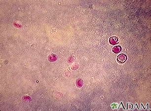 It affects the distal small intestine and can affect the respiratory tract in both immunocompetent. Cryptosporidium enteritis