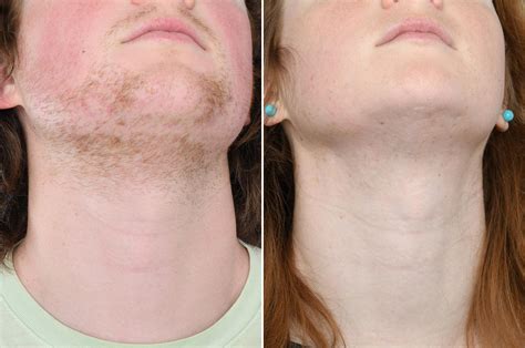 Result after 61 hours electrolysis before and after FFS - 2pass Clinic