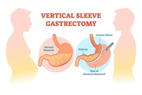 The procedure, technically simpler than a gastric bypass, does not involve rearranging the since this is a newer procedure, it is less likely that your insurance company will cover it. How Long Does A Gastric Sleeve Surgery Take? - Healthy ...