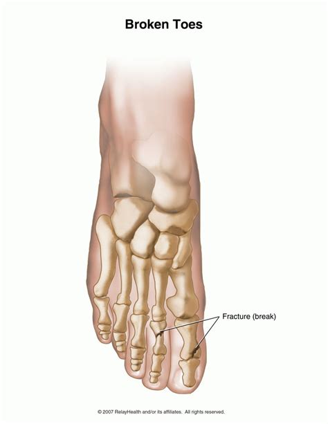 Touch =to put your hand or finger on. Broken Toe - Symptoms, Diagnosis, Treatment and Pictures