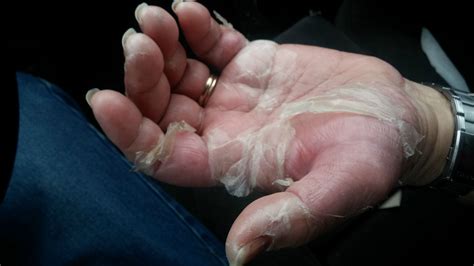 Another cause for peeling skin is generally dry skin. My mom's hands yesterday - adverse reaction to a new ...