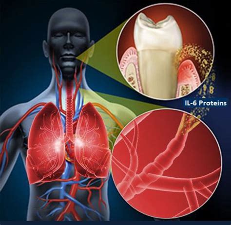 Gum Disease Heart Problem, Is There a Link Between them? - Welcome to ...