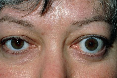 Side effects of dry eyes range from subtle eye irritation to significant swelling of the eye. Thyroid Antibody Levels Not Predictive of Clinical ...