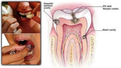 Agar sakit gigi bisa hilang secara keseluruhan, perlu dilakukan tindakan oleh dokter gigi untuk menghilangkan kausanya. Tips Hilangkan Sakit Gigi Hingga ke Akarnya yang Masih ...