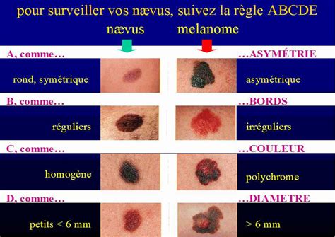 « l'aventure grain de beauté a commencé pour nous en septembre 2006 et en juillet 2007. Grain De Beauté Qui Grossit Et Change De Couleur - Choix ...