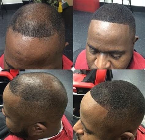 About 100,000 of them can be male pattern baldness is an inherited trait. Understanding Hair loss and its Types. : ThyBlackMan