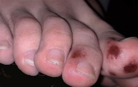 Di samping itu, ia boleh disebabkan oleh alergi terhadap beberapa makanan, dari reaksi buruk terhadap beberapa ubat atau penggunaan air atau makanan yang tercemar oleh protozoa. D0kt0r Sepany0l melap0rkan tanda baru C0vid 19, selain ...