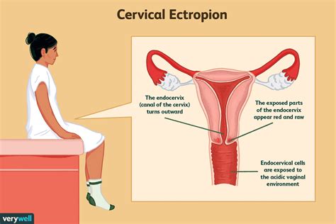The cervix is the lowest part of the uterus (womb). Ectropion cervical : Symptômes, causes, traitement