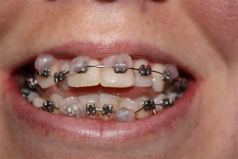 No matter how professional a specialist who installs braces, small problems can not be avoided. Braces + SARPE/SARME Surgery: Orthodontic WAX!!
