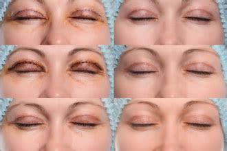 In many cases, the prolapsed gland is placed back if this type of surgery doesn't solve the problem, the gland may need to be surgically removed. Eyelid surgery: Options for improving appearance - All ...