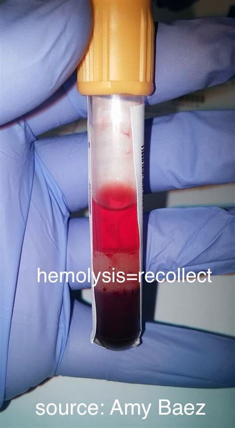 The blood is stirred with a wooden stick to rupture, or lyse, the red blood cells, a hemoglobinometer is used, green light is transmitted through the hemolyzed blood sample, and a comparison is made between the color intensity of the hemolyzed blood sample and standard color intensities. This sample is hemolyzed and is not suitable for ...