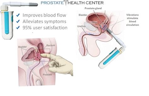 Proponents of prostate massage for prostatitis claim it helps by relieving tension in pelvic floor muscles, which men might be clenching due to stress. External Prostate Massage Techniques