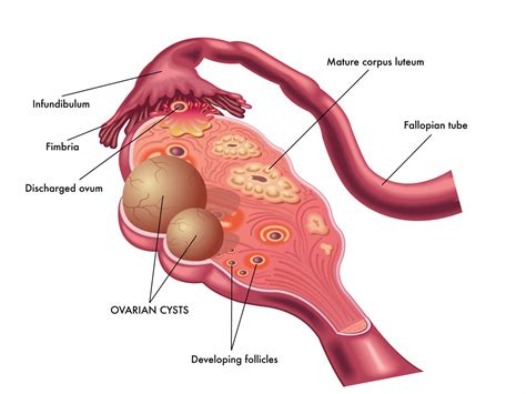Dermoid cysts in the brain: Ovarian cysts - Omnicare