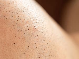 脱毛・ムダ毛処理の肌荒れ、埋もれ毛で肌が痒くなるのを解消 ...