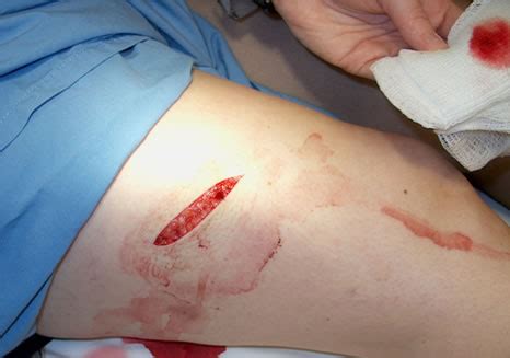 Wound Care - Wound Treatment