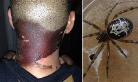 Symptoms, stages, causes, pictures and treatment information. PICTURED: False widow spider bite turned my neck BLACK ...