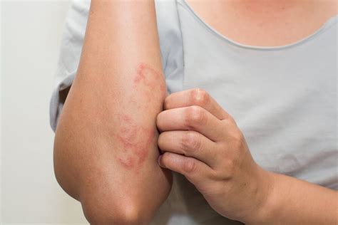 Dry skin is a skin condition which makes you uncomfortable, it turns plump cells into shrivelled ones and are you one of the sufferers from dry skin and searching for the natural home remedies to get rid of the problem? The Best Home Remedies for Skin Rashes | The Healthy
