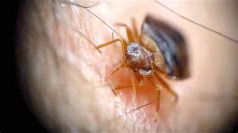 Les morsures de punaises de lit peuvent être confondues avec des piqûres de moustiques quels risques de maladies après une piqûre de punaise de lit ? punaise des lits (Cimex lectularius), piqûre en gros plan ...