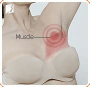 Learn about breast cancer types, including ductal carcinoma in situ (dcis), inflammatory breast cancer this benign (noncancerous) condition may cause a clear or bloody discharge from the nipple, or having one papilloma does not raise your breast cancer risk, though having several of these. Treating Breast Tenderness | Menopause Now