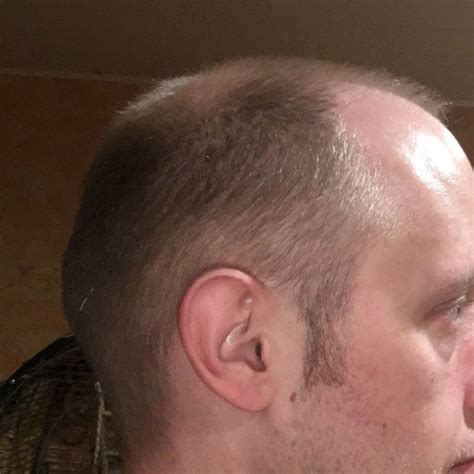 Ich glaub manchen ist der begriff 3 mm nicht . Glatze/Millimeter schnitt? (Haare, Friseur, Haarausfall)