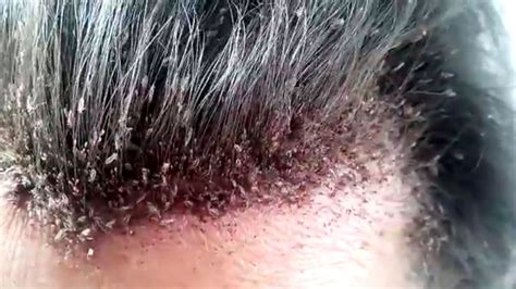 A study conducted in 1985 showed that roughly 10% of caucasian children got lice while only 0.3% of african american children got lice. This video of a man's disgusting head lice infestation ...