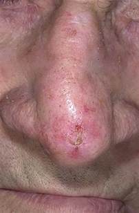 The most common symptoms of nasal and sinus cancer are: Skin Cancer on Nose Pictures - 12 Photos & Images ...