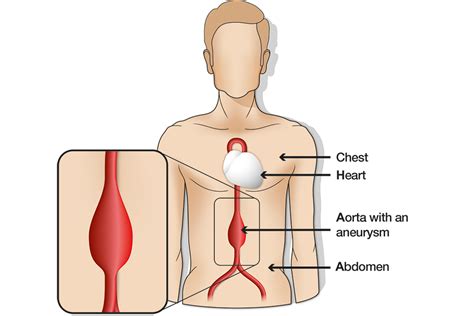 A formação de um aneurisma é bastante semelhante à situação absurda narrada. Os resultados do seu rastreio: tem um aneurisma da aorta abdominal (AAA) médio - GOV.UK