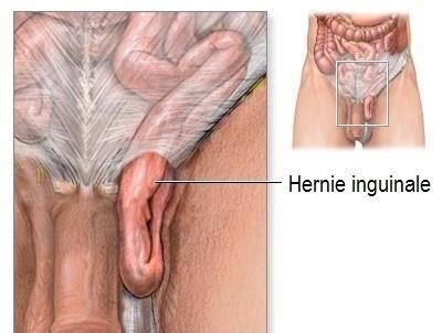 A l'occasion de la journée européenne de sensibilisation à l'arrêt cardiaque, lci vous si vous ressentez une douleur aiguë et persistante dans la poitrine irradiant le bras gauche, de dos et la mâchoire, appelez immédiatement le samu (15). Comment savoir si j'ai une hernie inguinale - 8 étapes