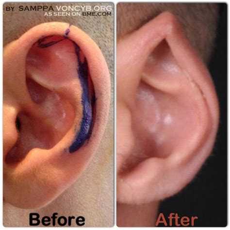 This type of procedure is mostly performed by body modification artists, piercers, and even tattoo artists as some doctors are not generally convinced the procedure is acceptable for some reasons. http://news.bme.com/wp-content/uploads/2012/11/samppa ...