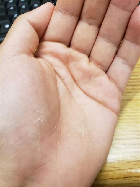 Why is my skin on my hands peeling? Palm and fingers are peeling but ...