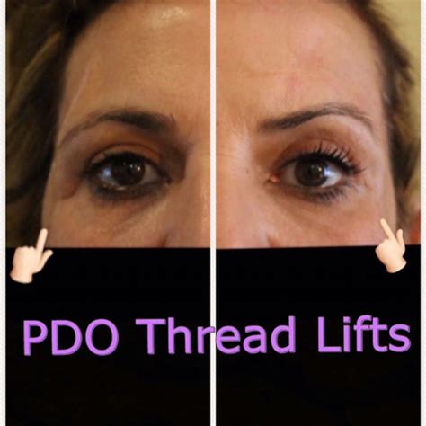 The empire pdo thread training is divided into two programs, level 1 and level 2, and a preceptorship for more advanced. Before/After Photos | adagio