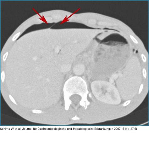 Processus falciformis, falciform ligament, ligamentum falciforme. Abbildung 3: Lungenfenster