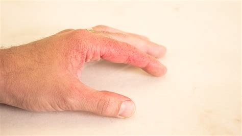 First Degree Burn Pictures / First Degree Burns vs Second Degree Burns - Difference and ...