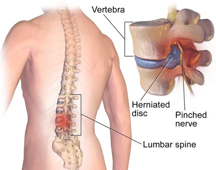 Lower Back Pain Treatment, Causes, Remedies | QI Spine Clinic