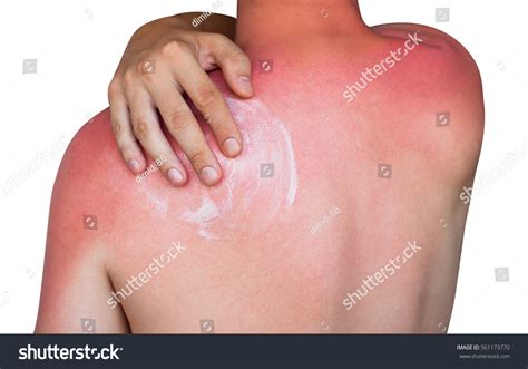 Man Reddened Itchy Skin After Sunburn Stock Photo ...
