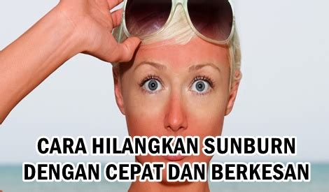 Tips rahasia bibir merah alami dengan cepat dan permanen. 7 CARA HILANGKAN SUNBURN DENGAN CEPAT DAN BERKESAN - BLOG ...