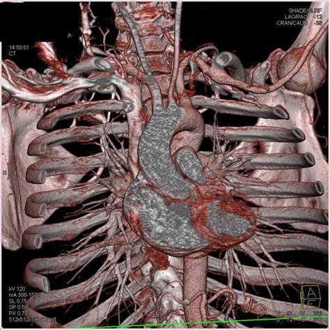 It ascends vertically to the root of the neck, opposite the left sternoclavicular. Left Subclavian Artery Aneurysm - Chest Case Studies ...