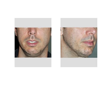 Maybe you would like to learn more about one of these? Case Study: Jawline Enhancement in the Thin Male Face ...