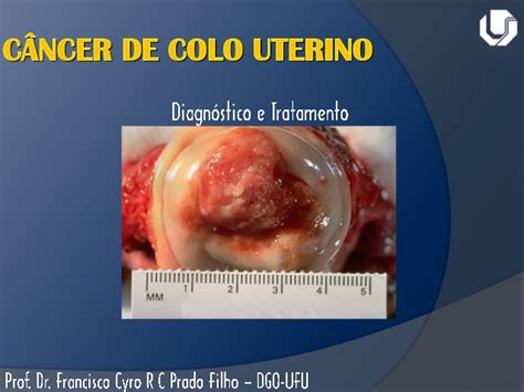 Consiste en la utilización de radiaciones ionizantes para destruir células tumorales causando el menor daño posible a los tejidos sanos que rodean al tumor. Câncer de colo uterino d iagnostico e tratamento