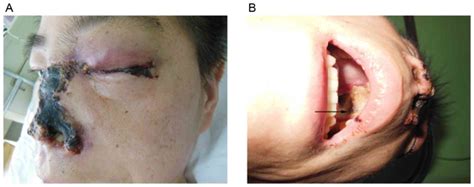 Mucormycosis can affect the lungs (pulmonary mucormycosis), most often when the pulmonary mucormycosis is often a rapidly progressive disease characterized by fever and a cough that does. Rapidly progressive rhino-orbito-cerebral mucormycosis in ...