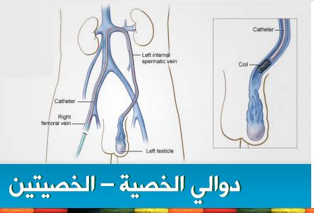 Check spelling or type a new query. علاج دوالي الخصية بالحجامة