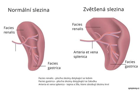 Výsledkom je chronické poškodenie pľúc, pankreasu a ďalších orgánov. Zvětšení sleziny - příznaky a léčba