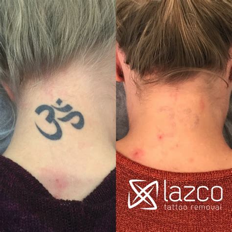 I heard about a procedure called picosure, but still need to do more. Brisbane Laser Tattoo Removal Clinic | Lazco Tattoo Removal