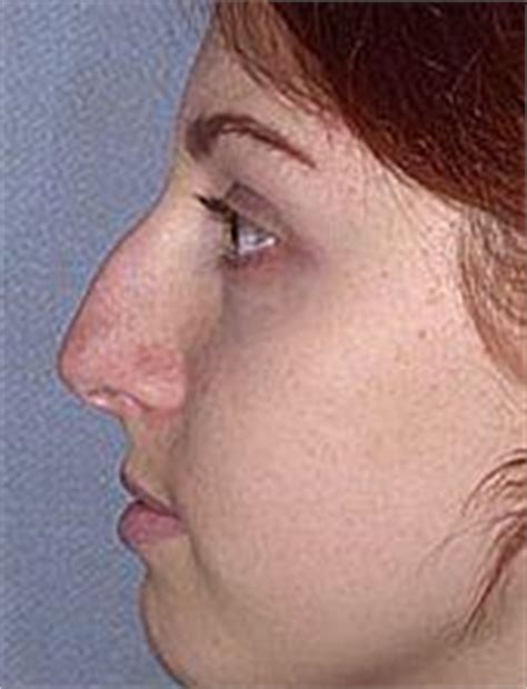 What causes a dorsal hump nose? Nose Job To Remove Hump Before & After Photos, Stony Brook ...