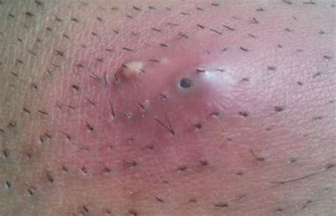 Help to spead up the clearing away of dead skin cells Treatment for Ingrown Pubic Hair | IYTmed.com