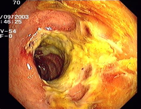 Find prescribing and patient information at the official hcp website. Diarrhoe als Leitsympton- Differentialdiagnosen im Überblick