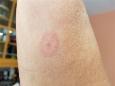 The longer the tick remains attached to your skin, the greater your. Lyme Disease Tick Bite Bullseye Pictures - Astigmatism Glaucoma Swollen Eyes Disease